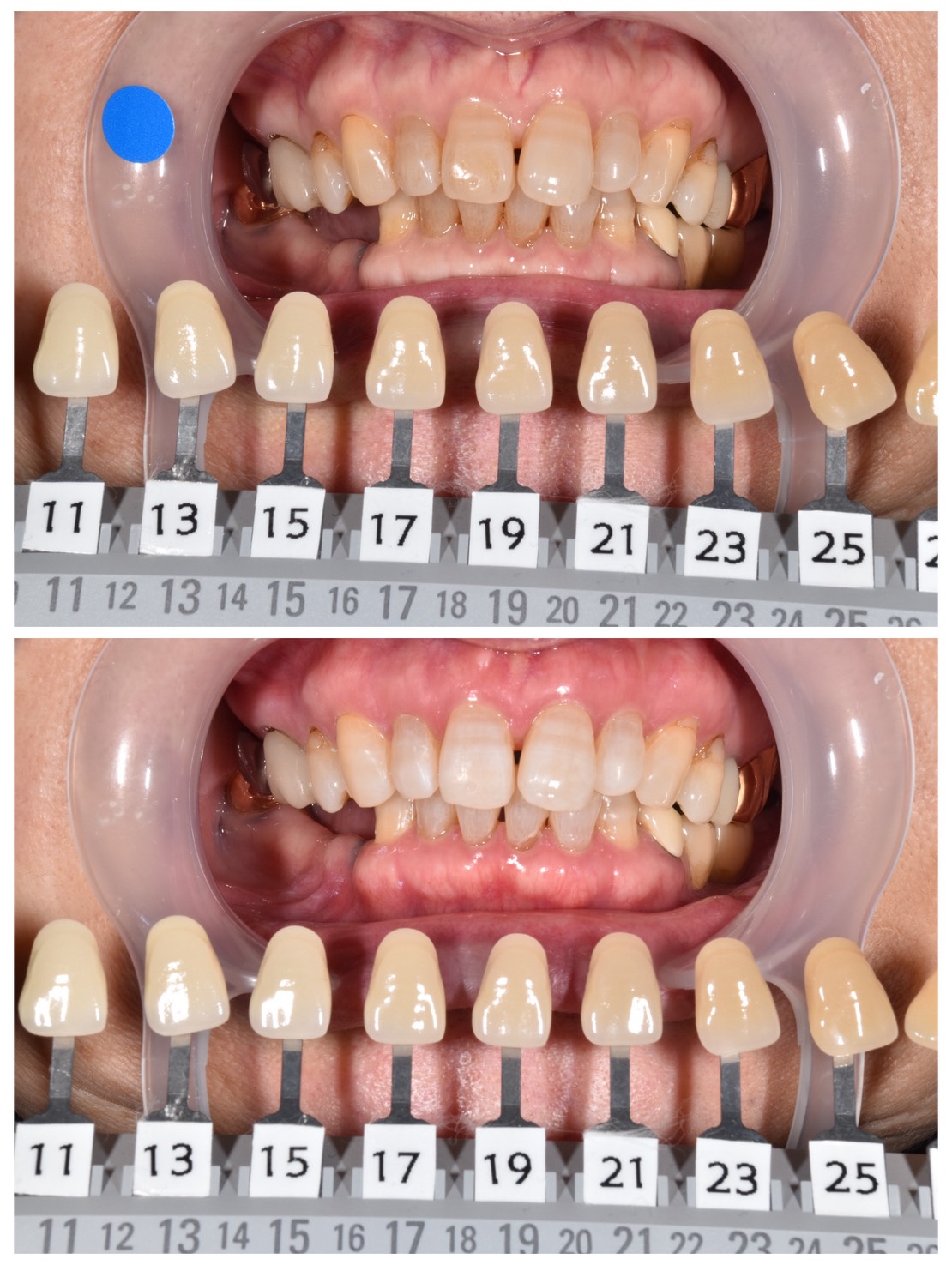 70代女性｜トランセントホワイトニングで自然な白さを実現した症例
