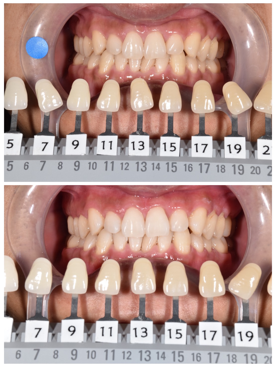 【症例】30歳男性｜トランセントホワイトニングと全顎クリーニングで透明感のある白い歯へ