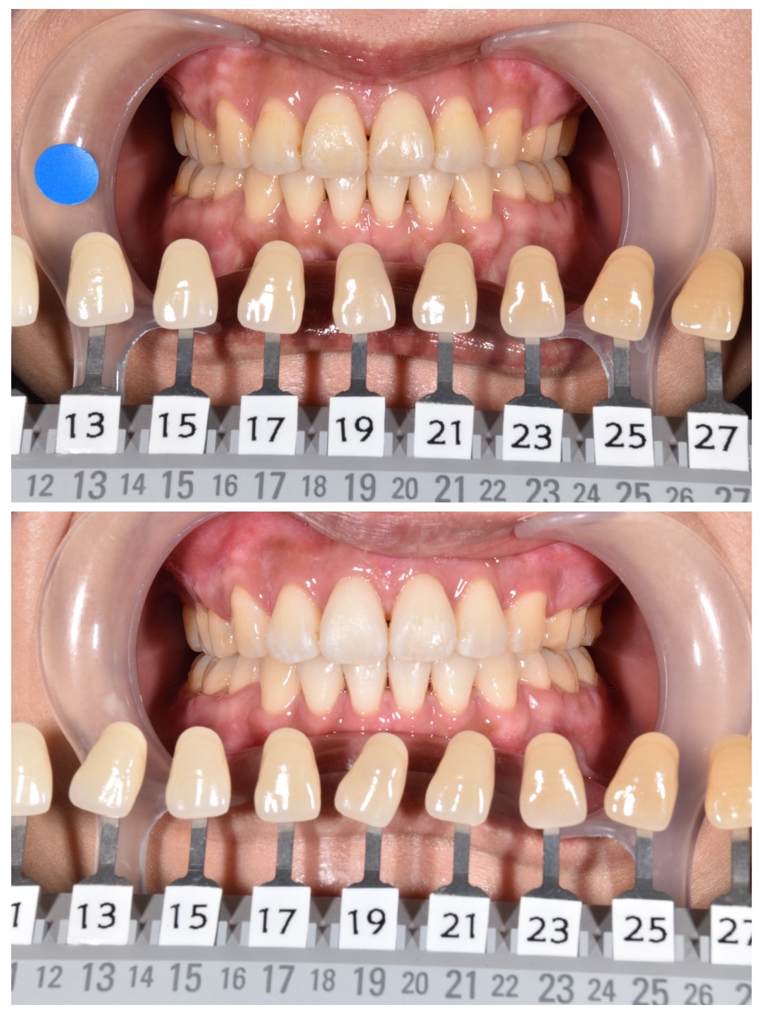 【症例】29歳女性｜結婚式前にトランセントホワイトニングで透明感のある白い歯へ