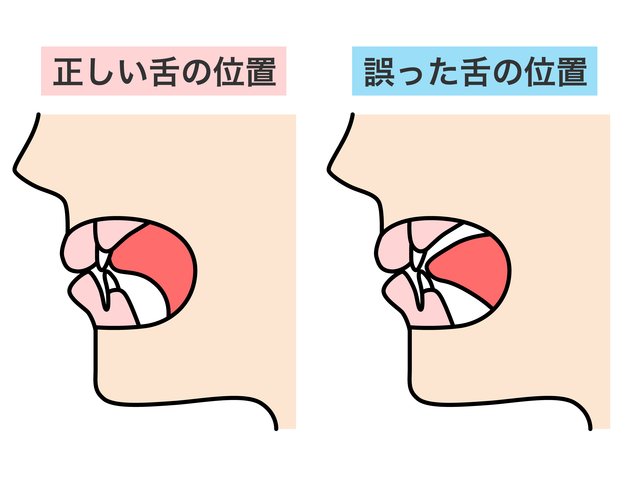 正しい舌の位置と誤った舌の位置の比較図