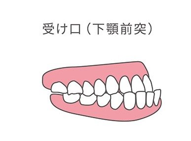 受け口(下顎前突)の歯並びイラスト