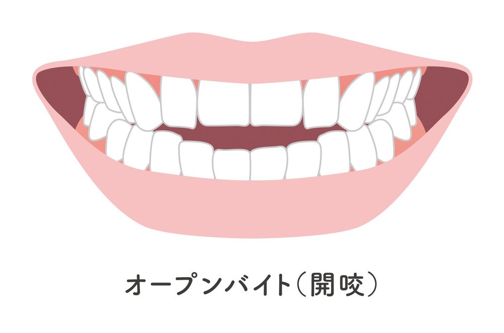 開咬(オープンバイト)の歯並びイラスト