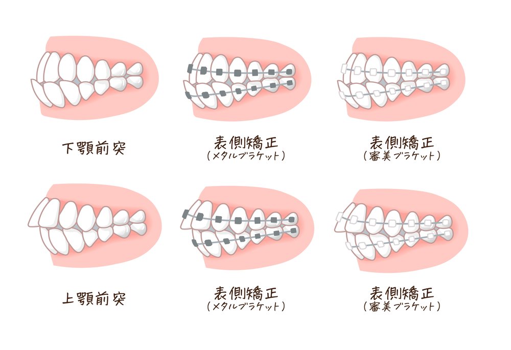 表側矯正・裏側矯正など矯正装置の種類の比較図