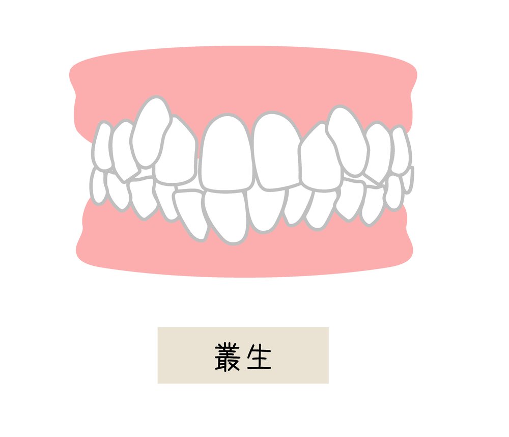 叢生(歯のデコボコ)の歯並びイラスト
